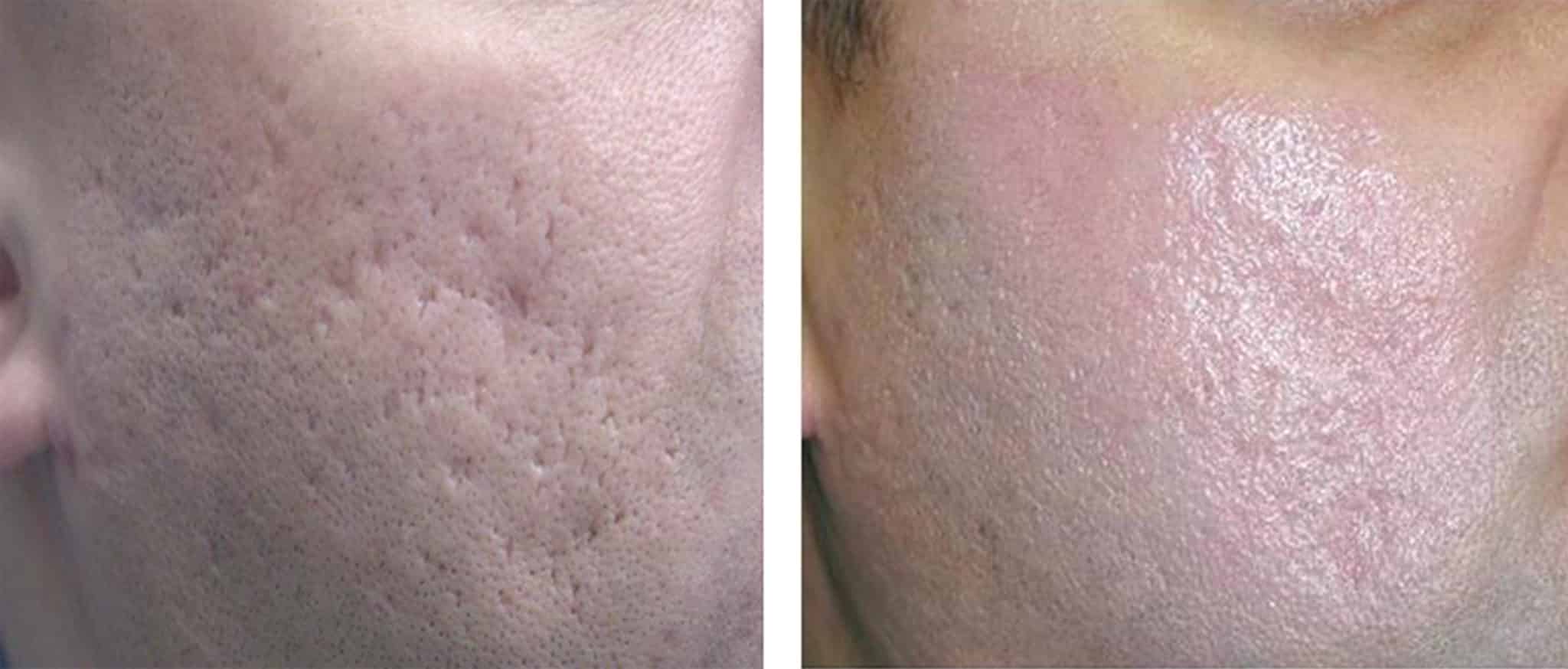 1735832385 Acne scars Patterned Er YAG courtesy of dr Matyunin 2048x874