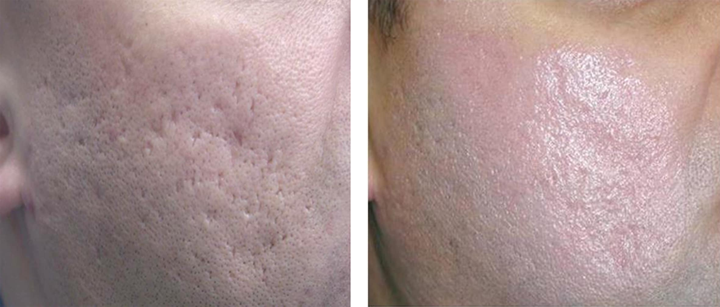 Before and After Image: Acne Laser Treament - right-front-oblique
